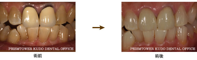 審美歯科症例Case 8